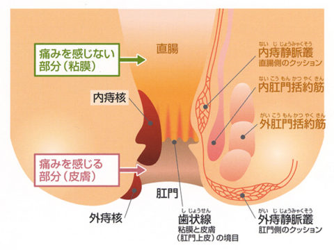 痔核のイラスト