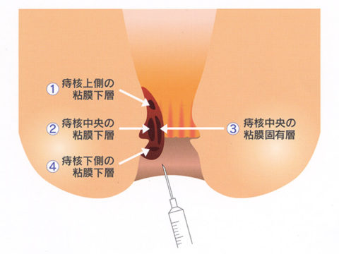 ジオン注投与方法